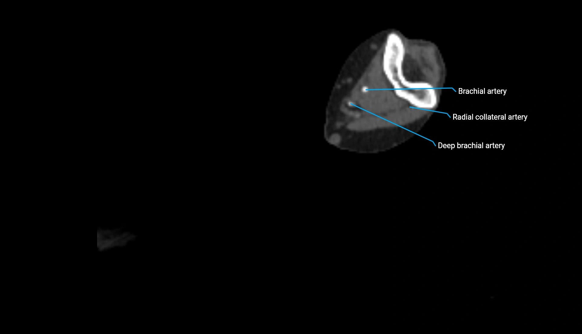 CTA upper limb axial cross sectional anatomy labelled image 197 (2).webp